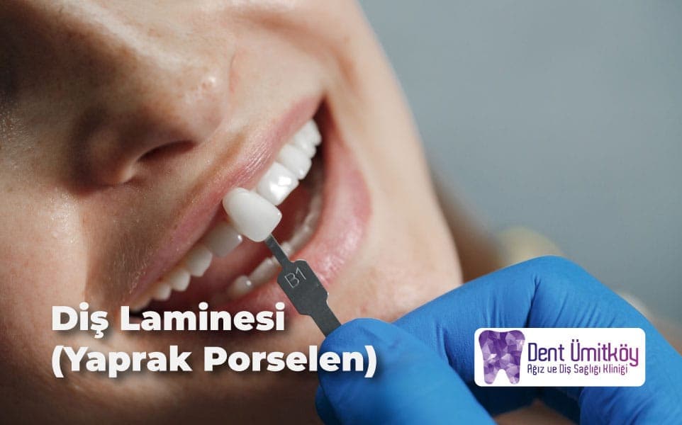 Ankara Diş Laminesi (Yaprak Porselen) Rehberi