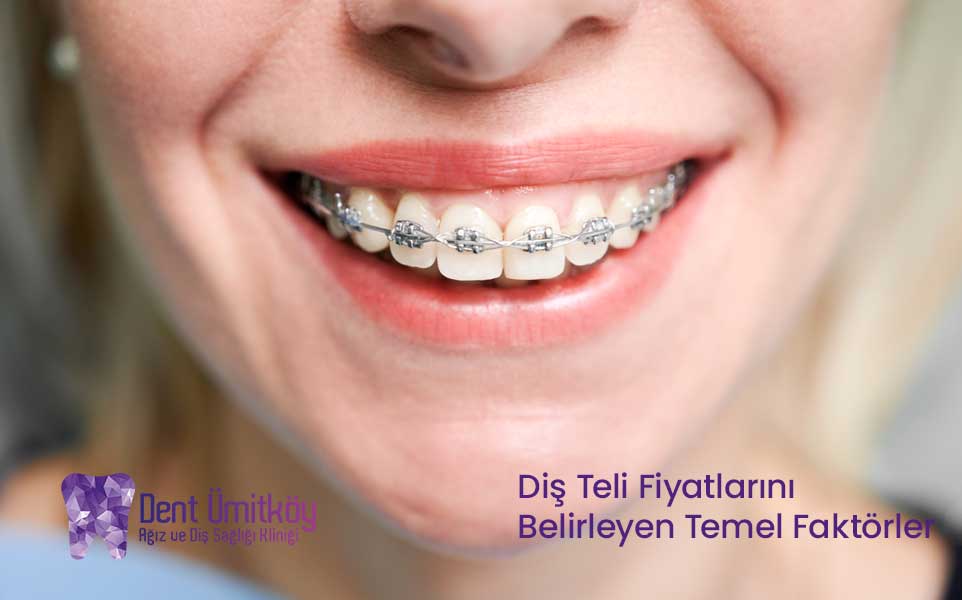 2026 Yılında Diş Teli Fiyatlarını Belirleyen Temel Faktörler