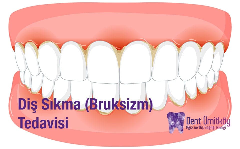Ankara Diş Sıkma (Bruksizm) Tedavisi