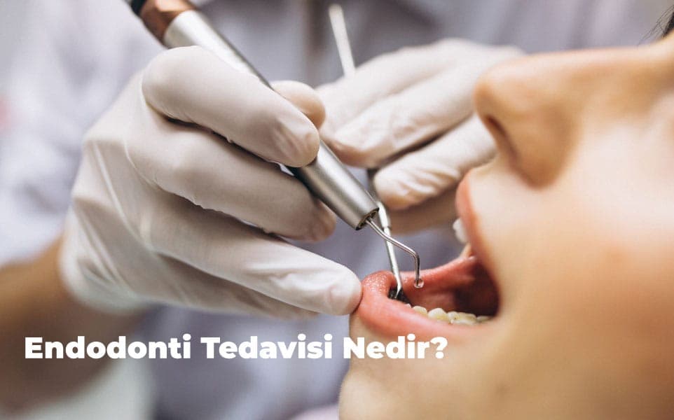 Ankara Endodonti Tedavisi: Dişinizi Kurtarmak İçin Bilmeniz Gerekenler