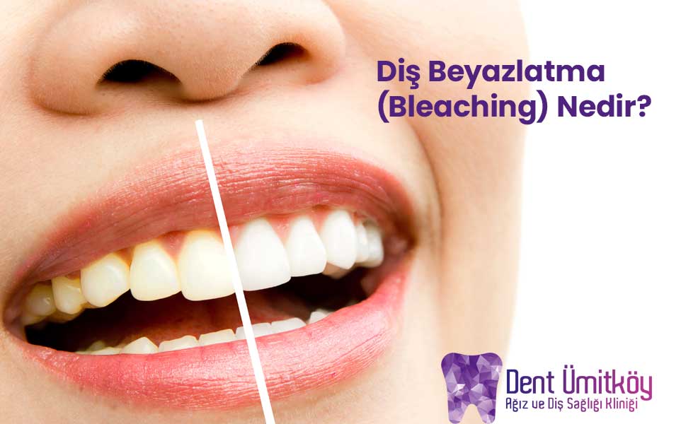 Diş Beyazlatma (Bleaching) Nedir?