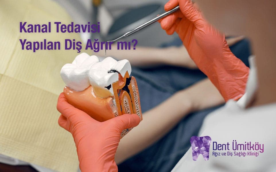Kanal Tedavisi Yapılan Diş Ağrır mı?