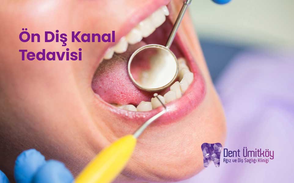 Ön Diş Kanal Tedavisi Nedir ve Neden Gereklidir?